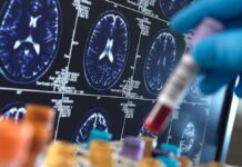 DESCUBREN LA PRIMERA TRANSMISIÓN ACCIDENTAL DEL ALZHÉIMER